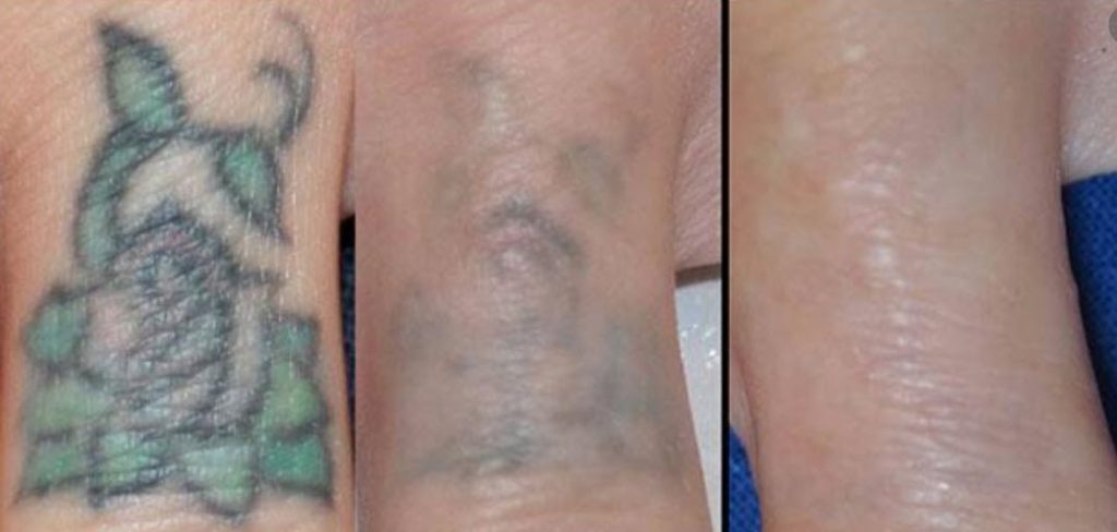 How do you remove a tattoo safely?